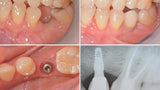 Impact Compressive Sharp Tip Dental Implant 4.20 mm