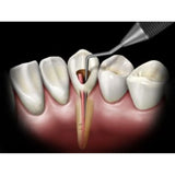 Api Root Canal Plugger -(.60mm) RCP60#3#1