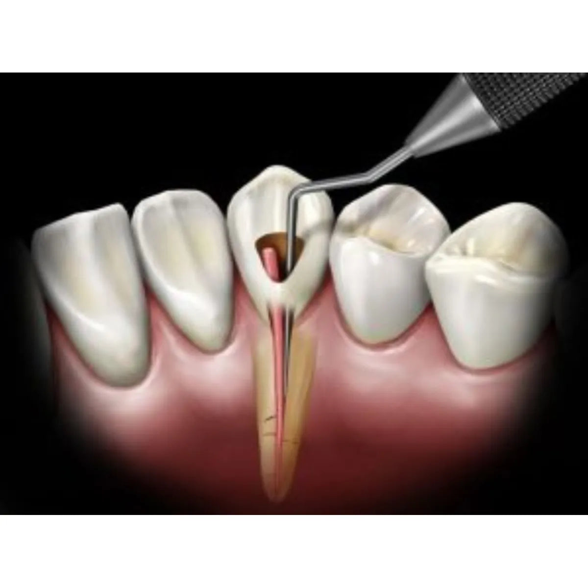 Api Root Canal Plugger -(.60mm) RCP60#3#1
