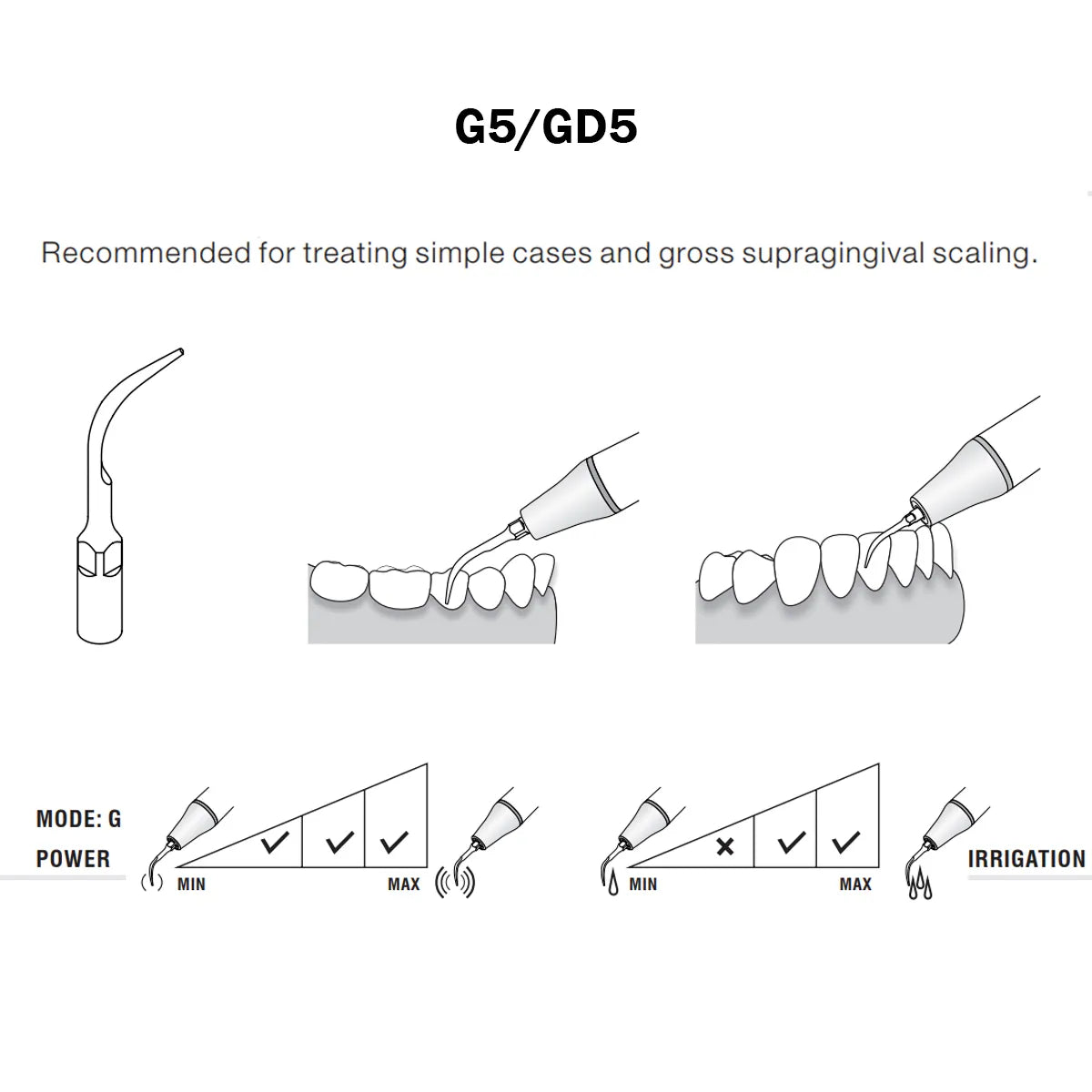 Woodpecker Scaler Tip GD5 for DTE & Satelec Scalers