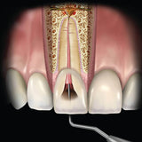 Api Root Canal Plugger -(.60mm) RCP60#3#1