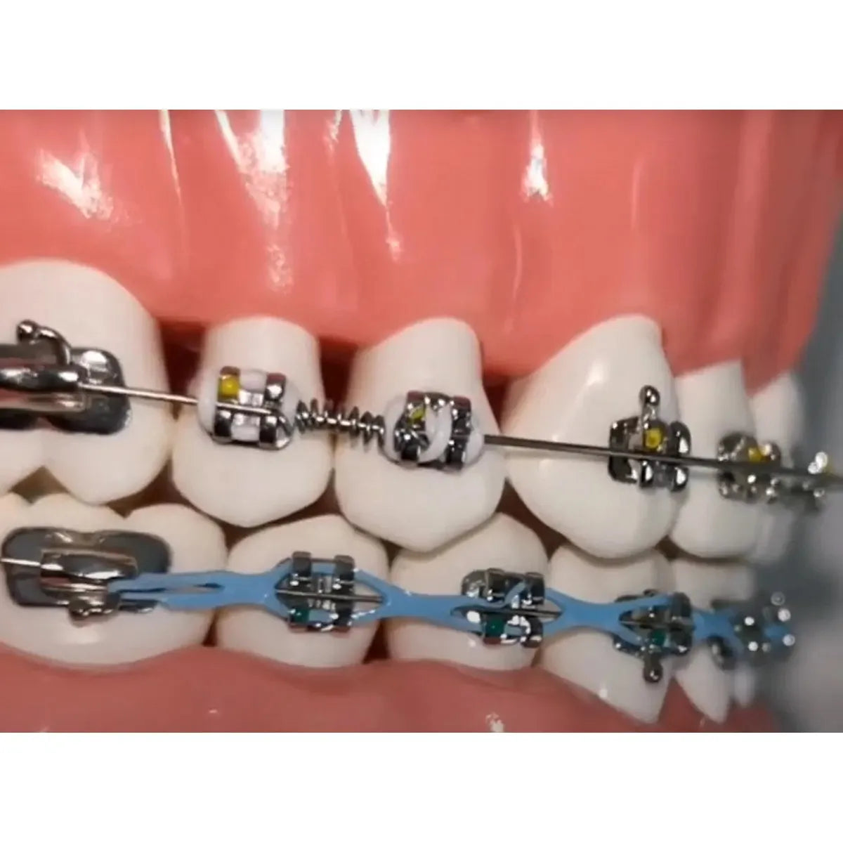 OrthoMetric Flexy NiTi Orthodontic Springs