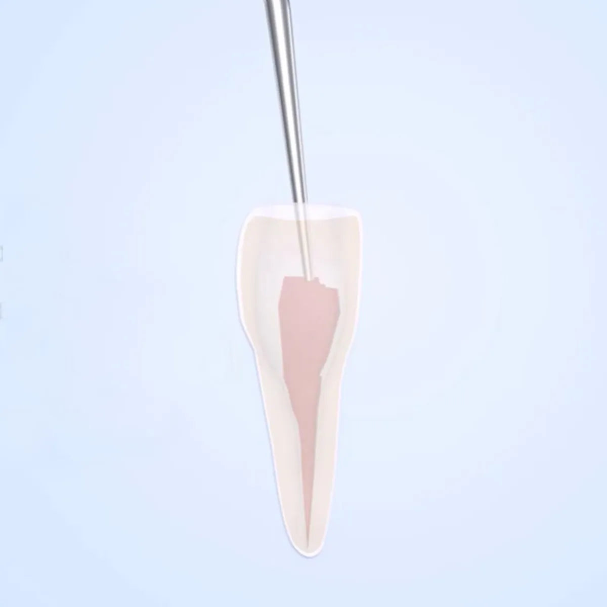 Woodpecker Scaler Tip E3 for UDS & EMS Scalers