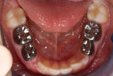 3m Espe Stainless Steel Primary Crown E( 2nd Molar)