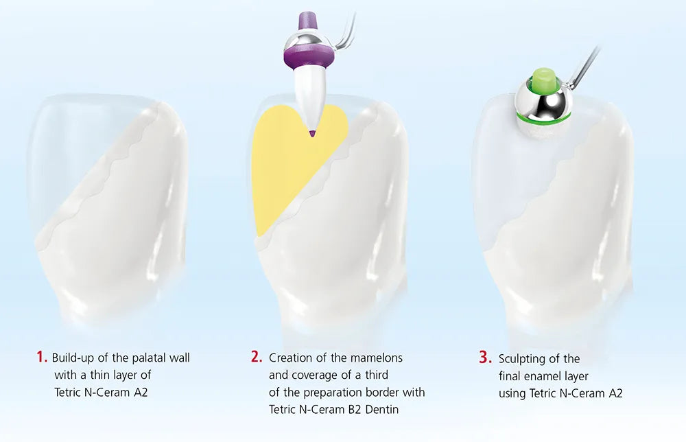 Ivoclar Tetric N-Ceram Composite Refill