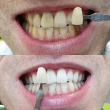 Maarc Blitz White Bleaching Kit