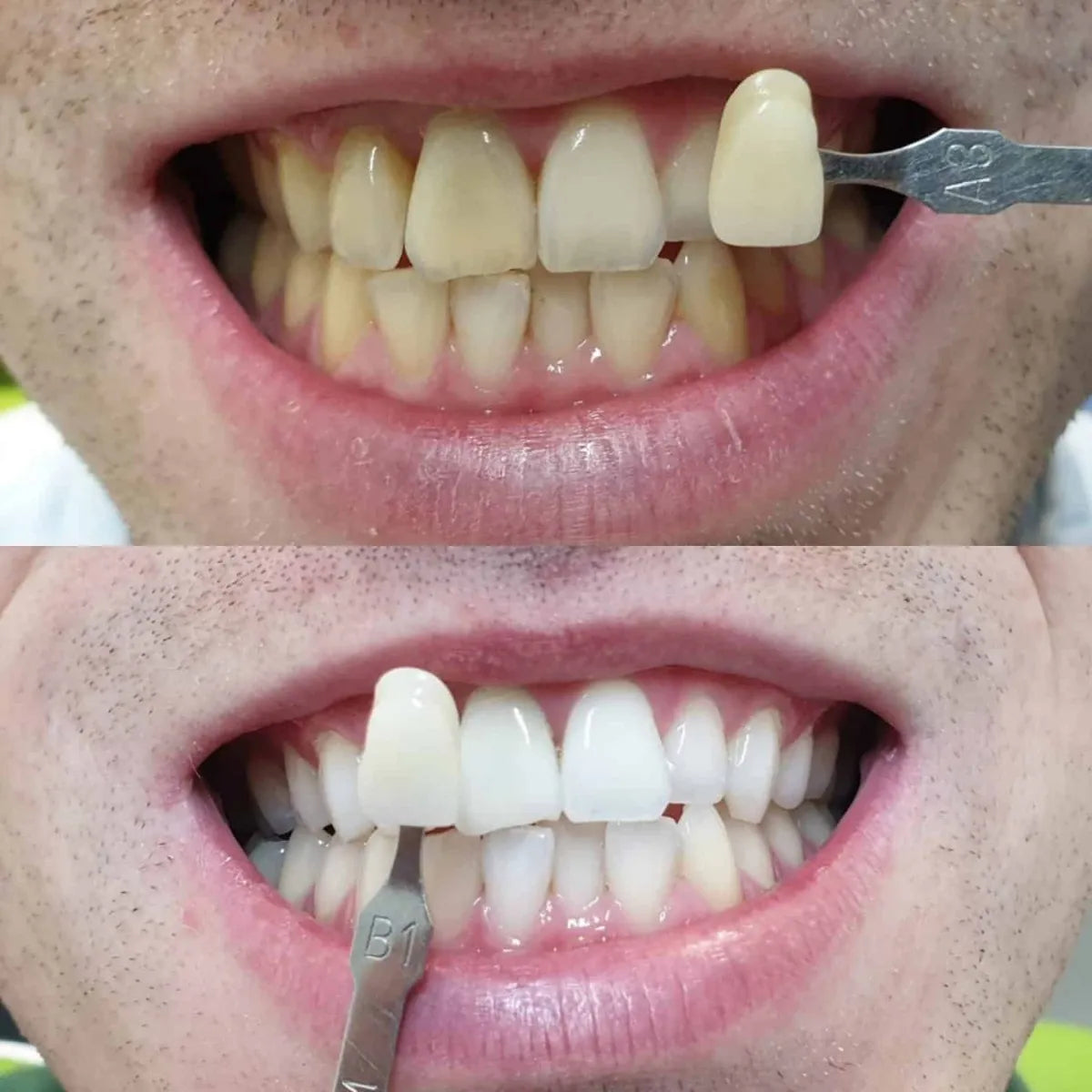 Maarc Blitz White Bleaching Kit