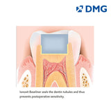 DMG Ionosit - Light Cured Baseliner Material
