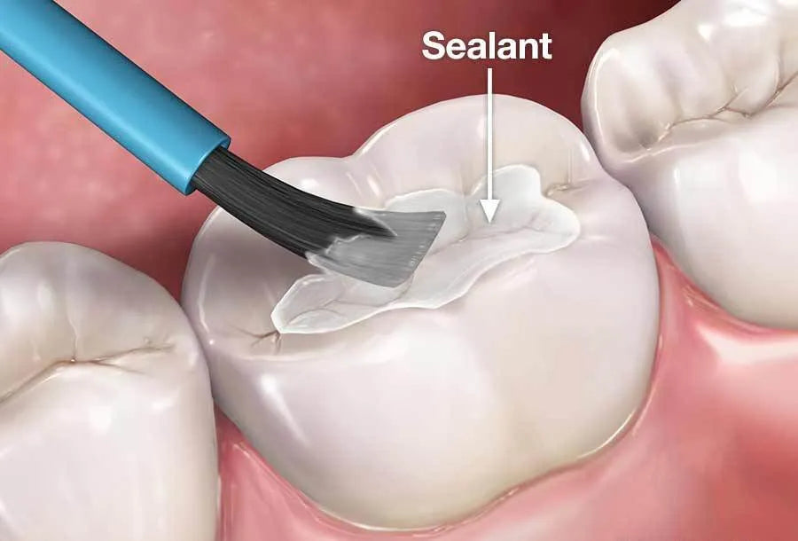 SDI Conseal F Pit & Fissure Sealant