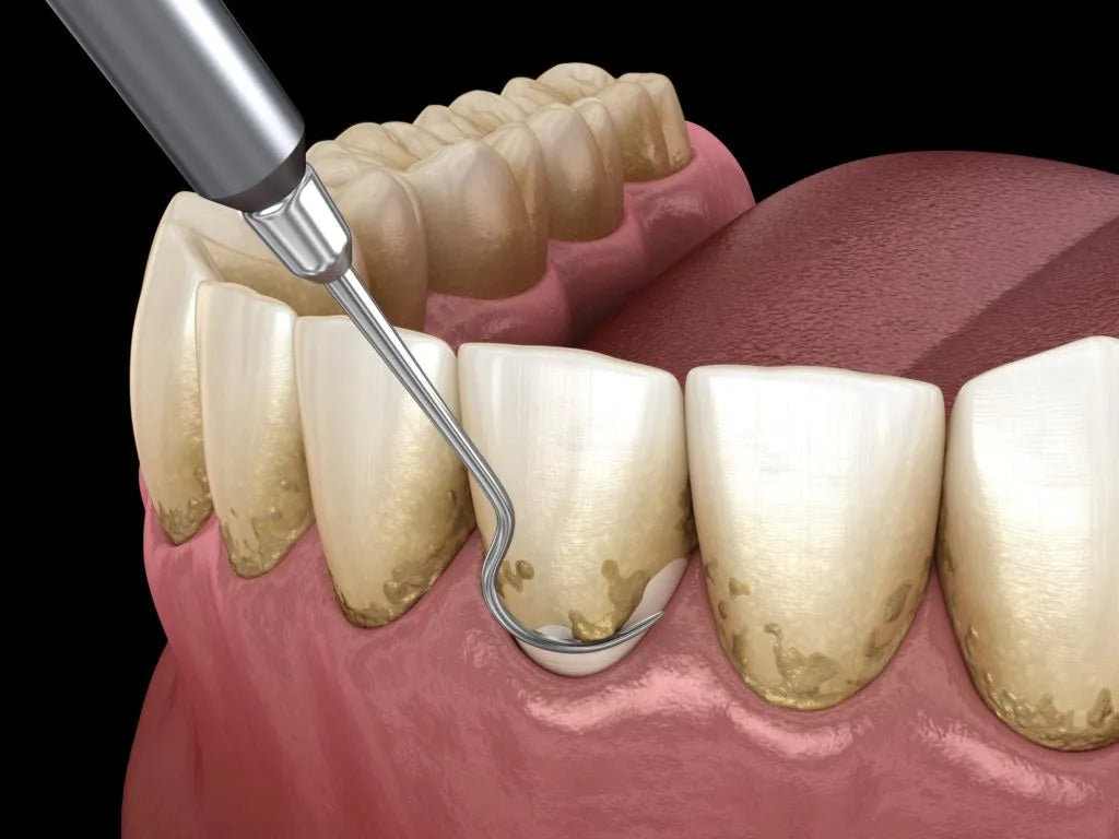 Api Dental D/E Probe