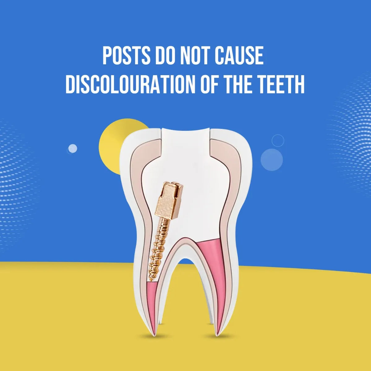 EndoKing Dental Conical Screw Posts