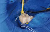 Ivoclar Optrastick Refill 48