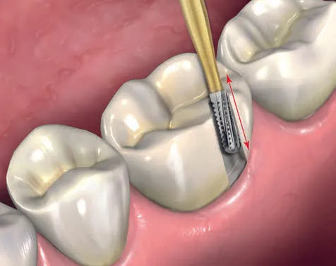 Prima Dental Predator Turbo Crown Removal Kit
