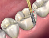 Prima Dental Predator Turbo Crown Removal Kit