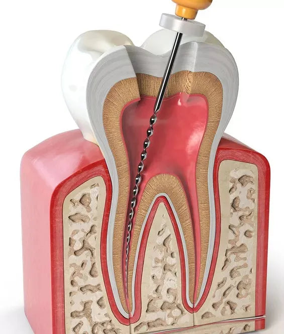 Dentsply M-Access H-Files -31mm (Hand Operated Files)