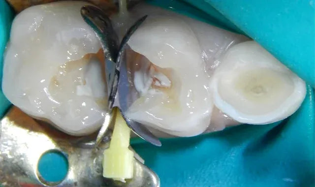 SafeEndo ReGlass LC