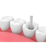 Endoking Fiber Post Refills