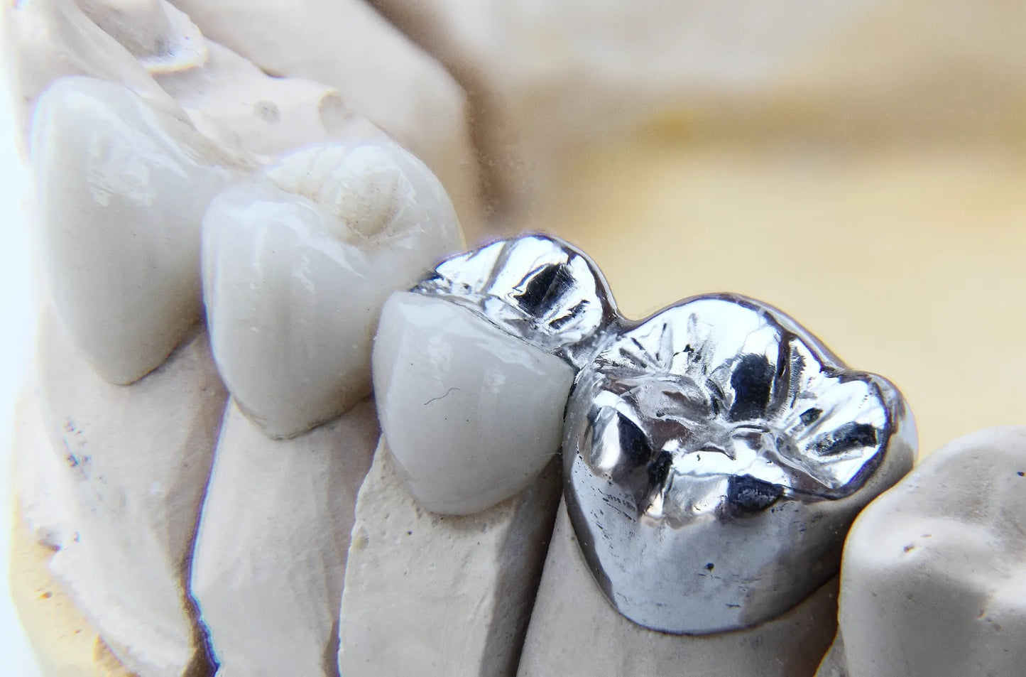 Dentsply StarLoy N Dental Alloy Meta