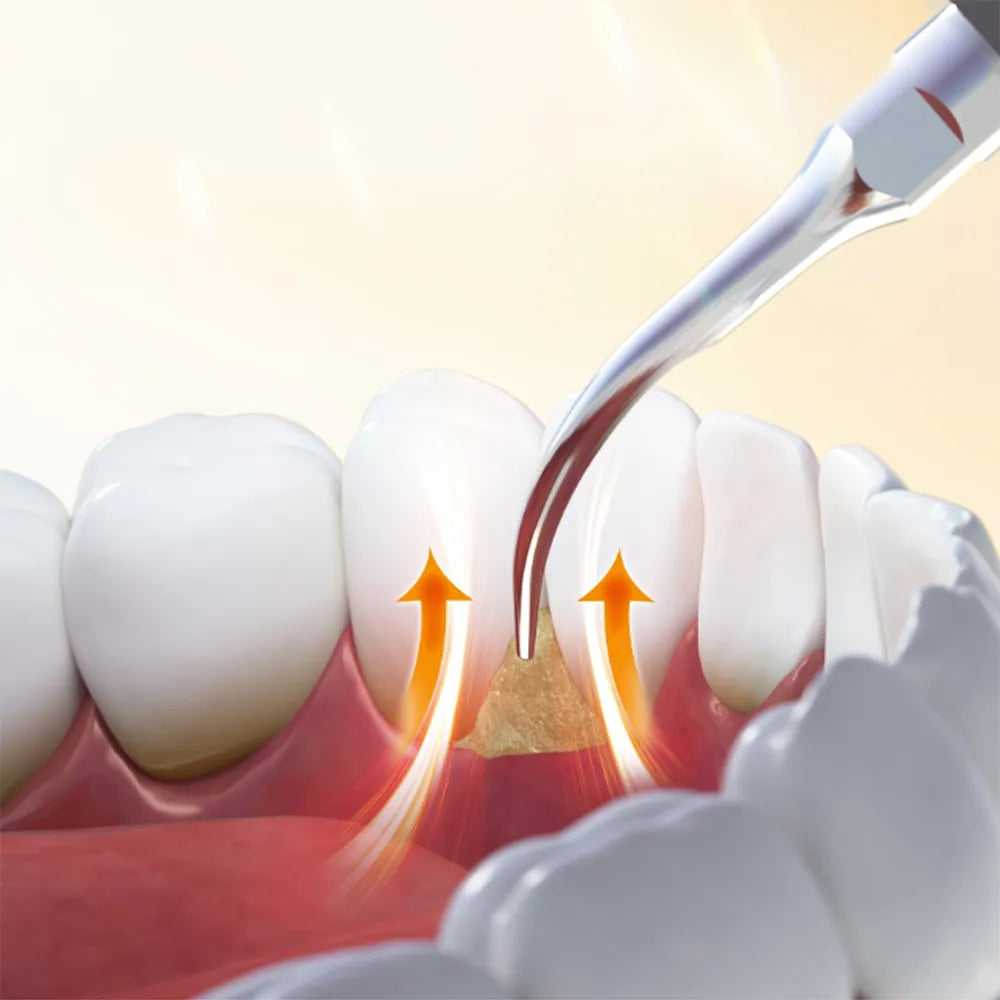 Woodpecker Scaler Tips for DTE & Satelec Scalers