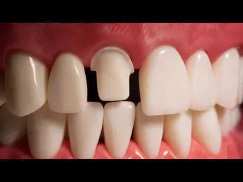 API Typodont Teeth Set with Screw