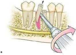 Dental  Luxator Set of 10