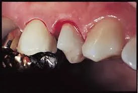 Prevest Hemostal Gel