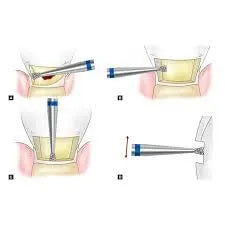 Mani Diamond Burs - Si Series