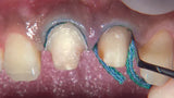 Api Gingivial Cord Packer Serrated #1 #3 (Gcp113)