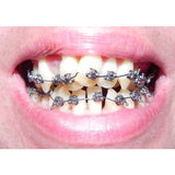 D-Tech Precimax (MIM MBT Prescription Brackets)