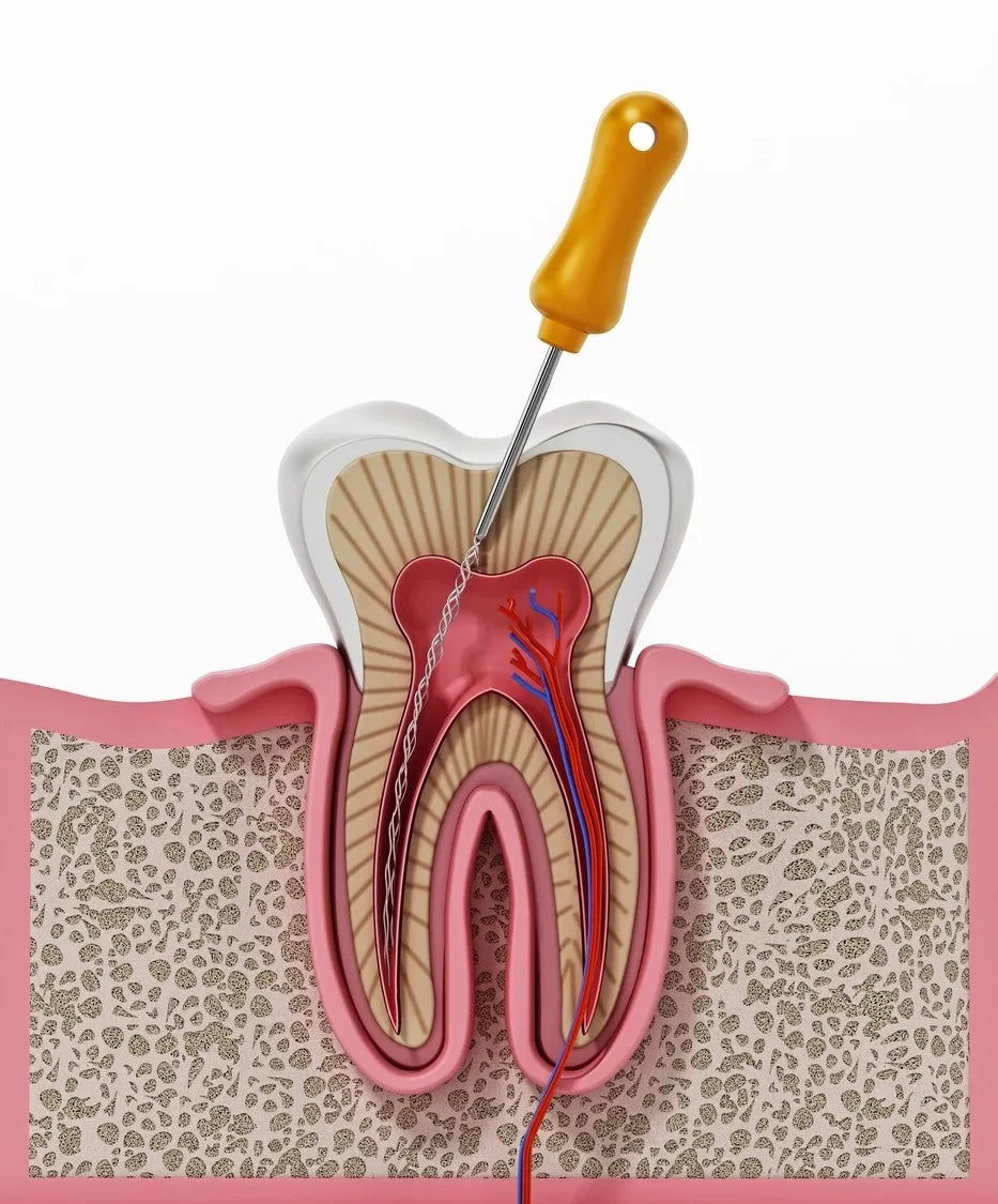 Dentsply M-Access H-Files -31mm (Hand Operated Files)