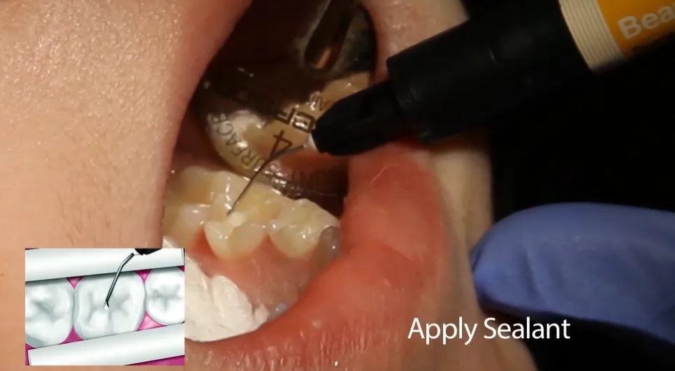 Shofu BeautiSealant Pit & Fissure Sealant