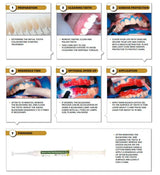 Mani Bleach N Shine One Patient Kit