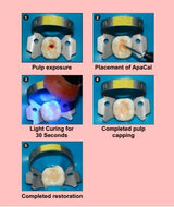 Prevest ApaCal ART