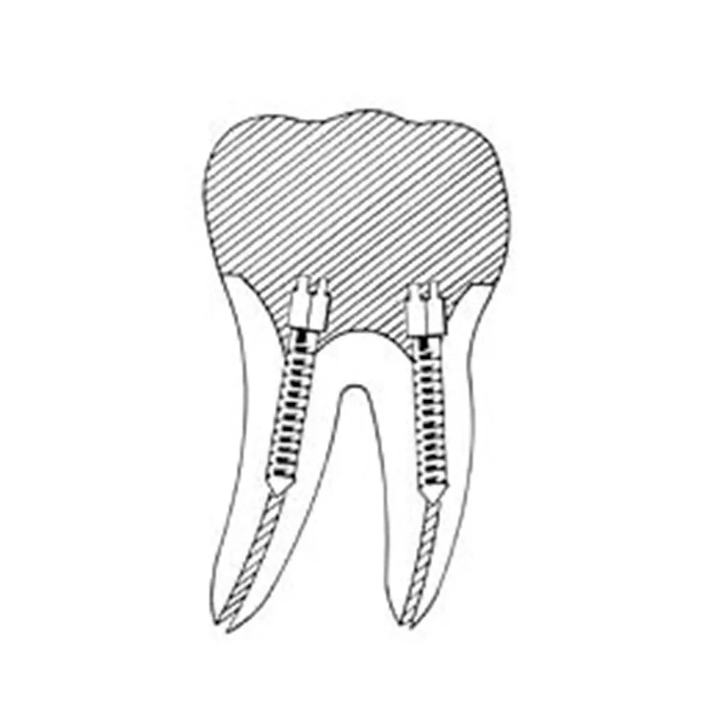 EndoKing Dental Conical Screw Posts