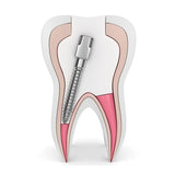EndoKing Dental Conical Screw Posts