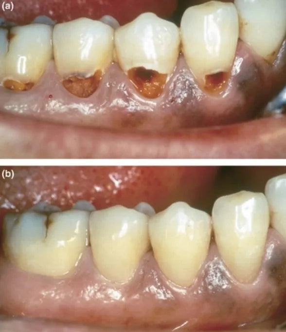 Prevest Crysta Restorative II GIC